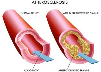 Atherosclerosis in Diabetes