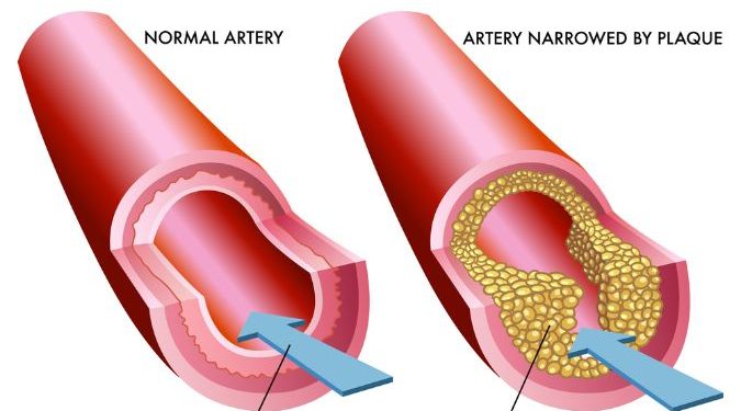 Atherosclerosis in Diabetes