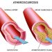 Atherosclerosis in Diabetes
