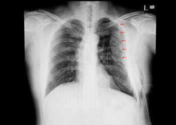 Lung Contusion Symptoms