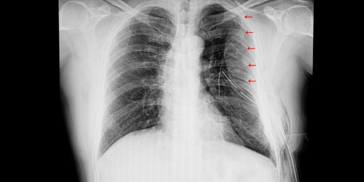 Lung Contusion Symptoms