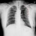 Lung Contusion Symptoms