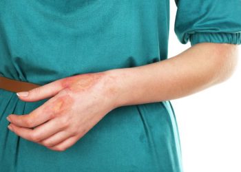 How to Treat Burn Symptoms