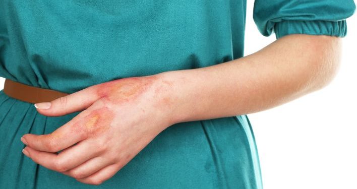 How to Treat Burn Symptoms