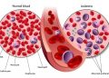 Chronic Myelocytic Leukemia Symptoms and Treatments