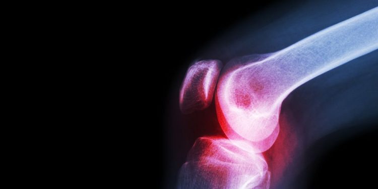 Septic Arthritis