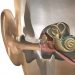 Inner Ear Diseases Symptoms and Treatment