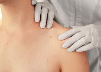 Hepatocellular Carcinoma