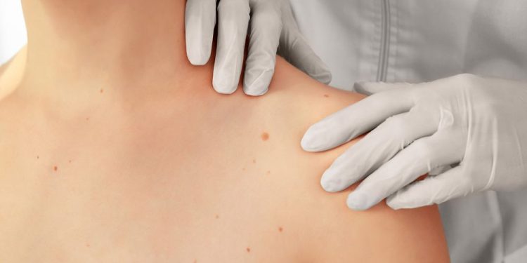 Hepatocellular Carcinoma