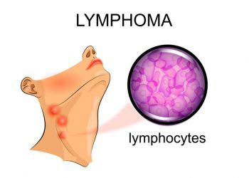 What is Stage 4 Lymphoma?