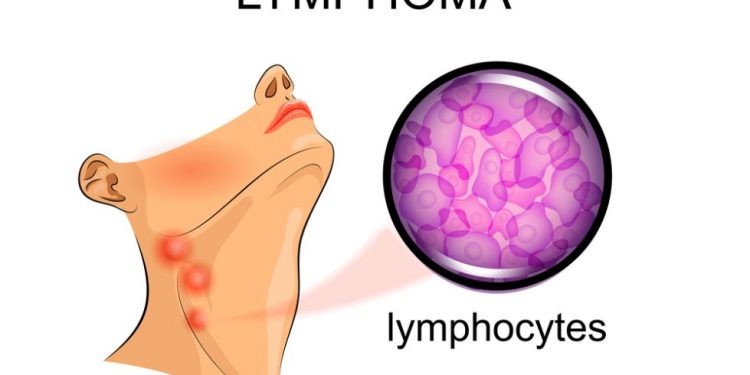 What is Stage 4 Lymphoma?