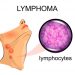 What is Stage 4 Lymphoma?