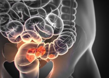 Rectal Cancer – What You Need to Know