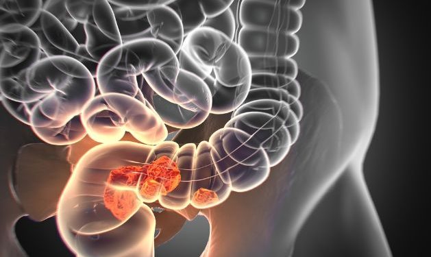 Rectal Cancer – What You Need to Know