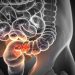 Rectal Cancer – What You Need to Know
