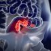 Colorectal Cancer