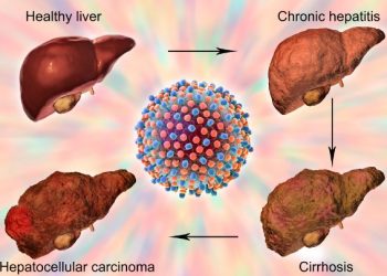 Hepatocellular Disease