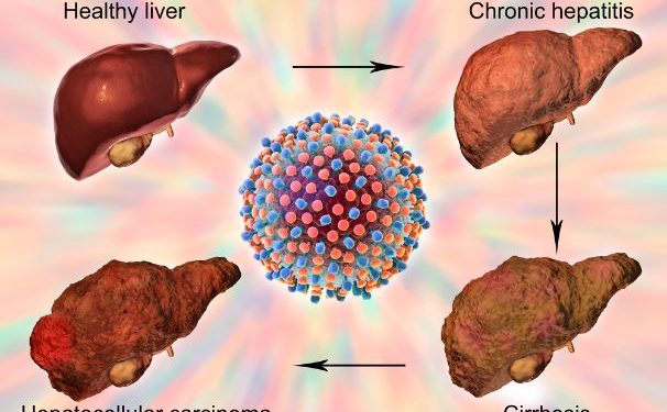Hepatocellular Disease