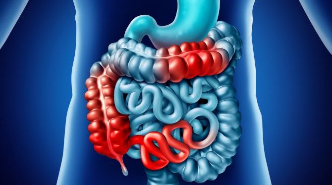 Hirschsprung Disease Symptoms