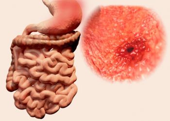 Stress Ulcer Symptoms