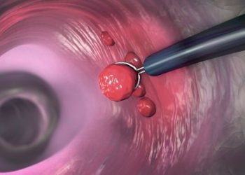 Colon Polyps and Colorectal Cancer