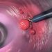 Colon Polyps and Colorectal Cancer