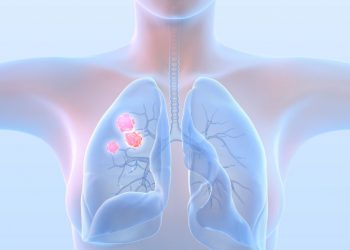 The Stage 4 Lung Cancer Survival Rate by Age