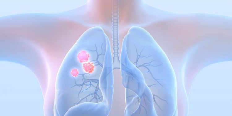 The Stage 4 Lung Cancer Survival Rate by Age