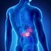 Pancreatic Cancer