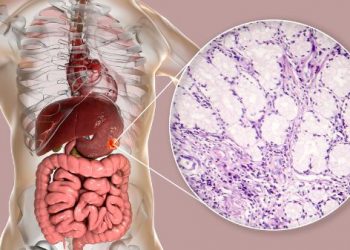 Adenocarcinoma Colon Cancer