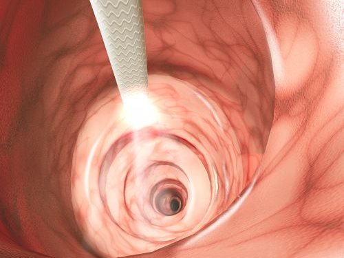 Colorectal Cancer Symptoms and Screening