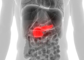 How to Treat Stage 4 Pancreatic Cancer