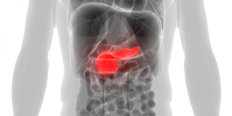 How to Treat Stage 4 Pancreatic Cancer
