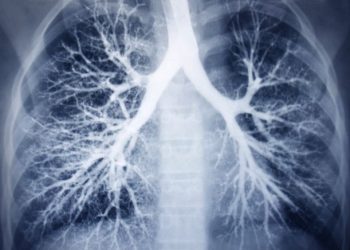 Lung – Congenital Defects Symptoms