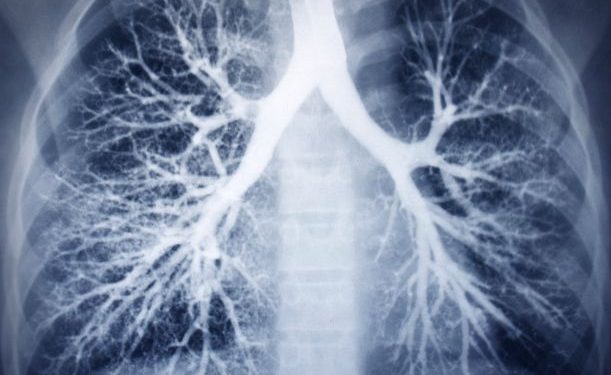 Lung – Congenital Defects Symptoms
