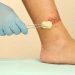 Leg Ulcer