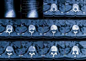 Degenerative Diseases of the Vertebra Symptoms