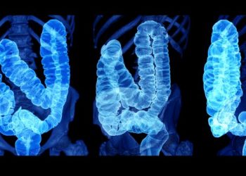 Colon Cancer – What is It?
