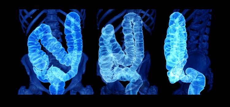 Colon Cancer – What is It?