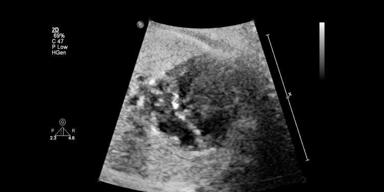 Congenital Anomalies of the Airways Symptoms