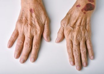 Henoch-Schonlein Purpura