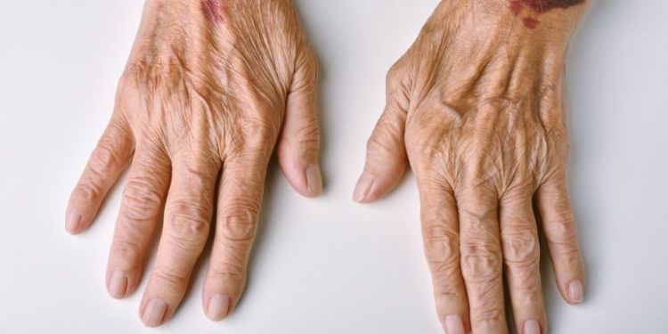 Henoch-Schonlein Purpura