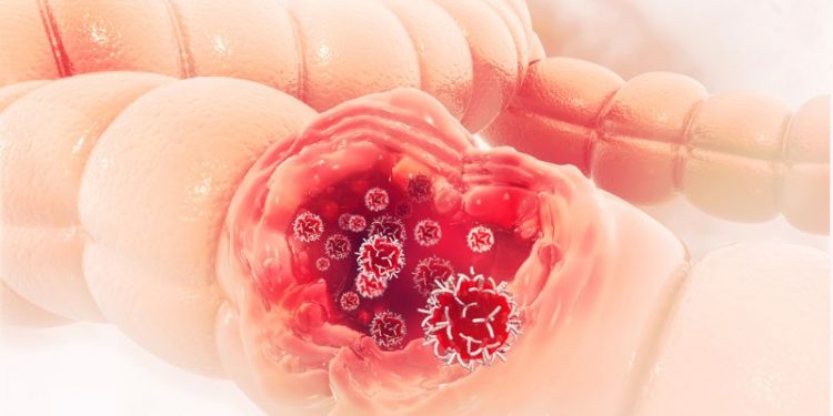 The Stages of Colon Cancer