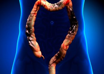 Stage 4 Colon Cancer