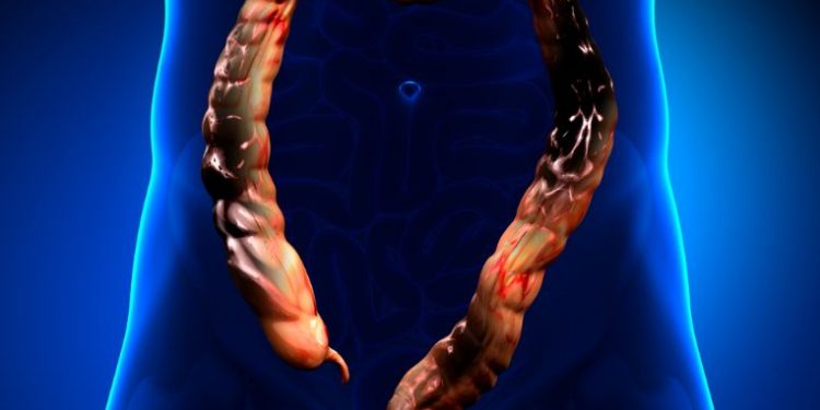 Stage 4 Colon Cancer