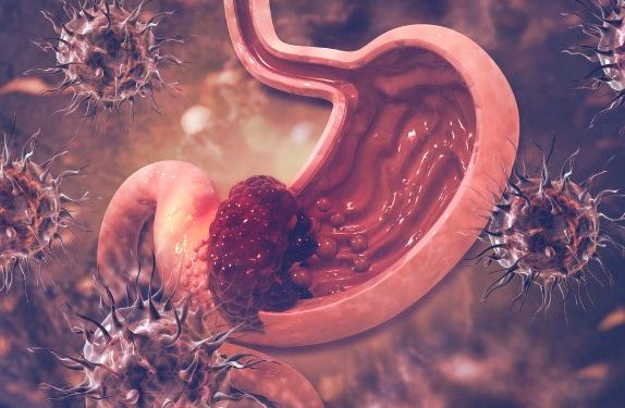 Stomach Cancer – What You Need to Know