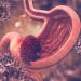 Stomach Cancer – What You Need to Know