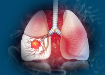 Interstitial Lung Disease Symptoms