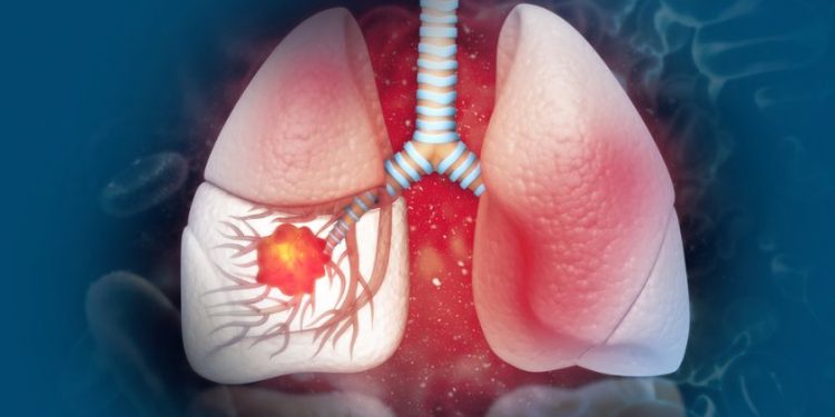 Interstitial Lung Disease Symptoms