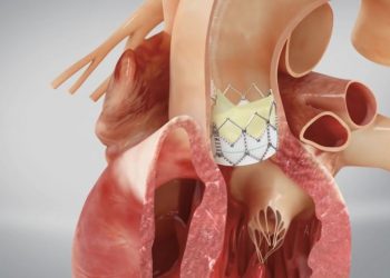 Aortic Valve Symptoms